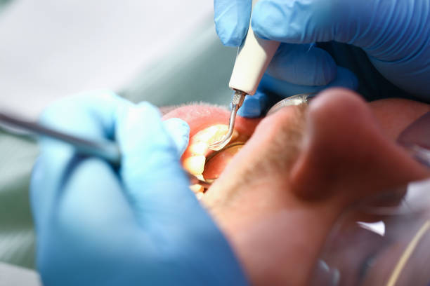 Best Emergency Root Canal Therapy in St James, MN